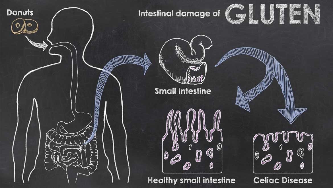Gluten intolerance